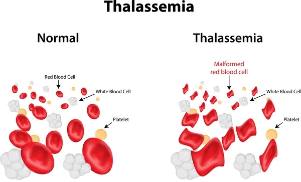 thalassemia.webp